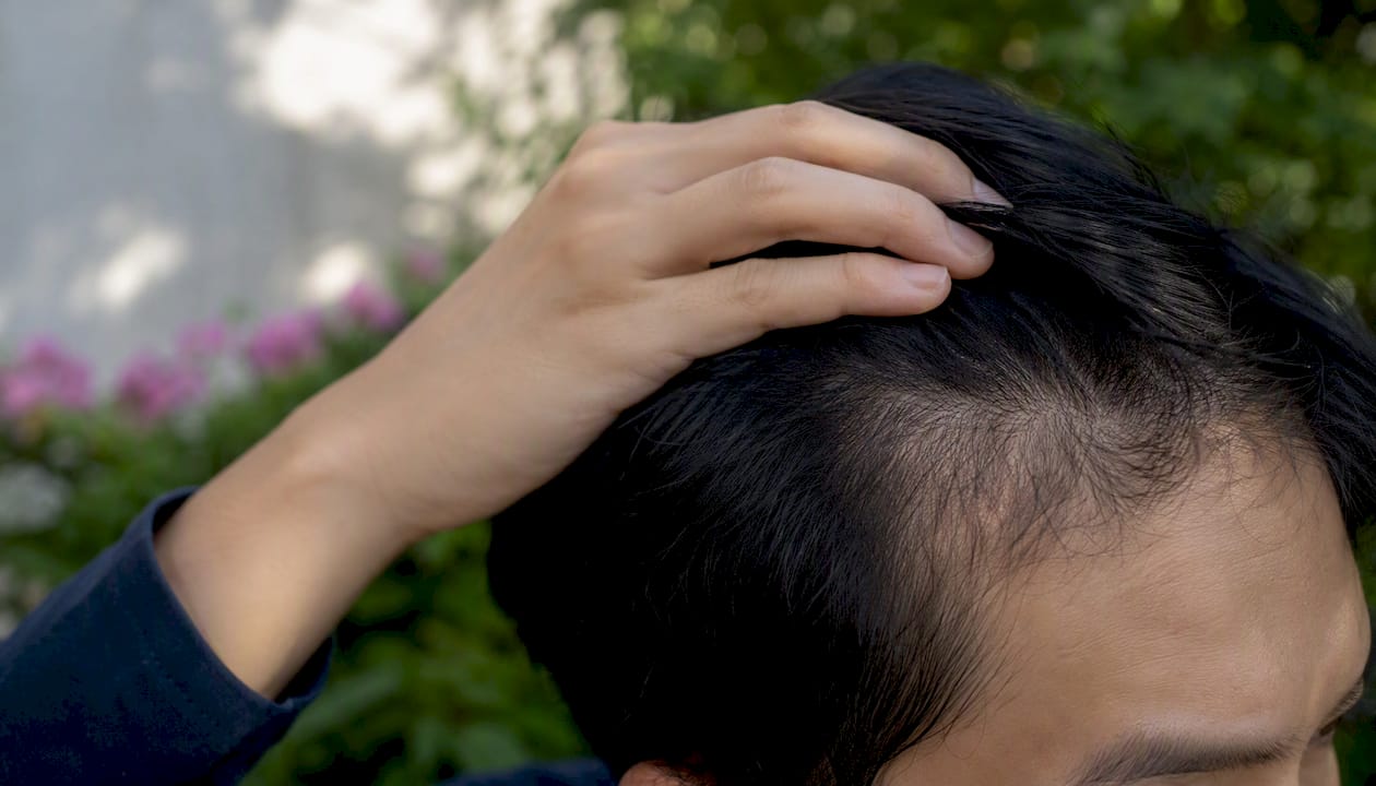 Close-up of scalp examined by hand