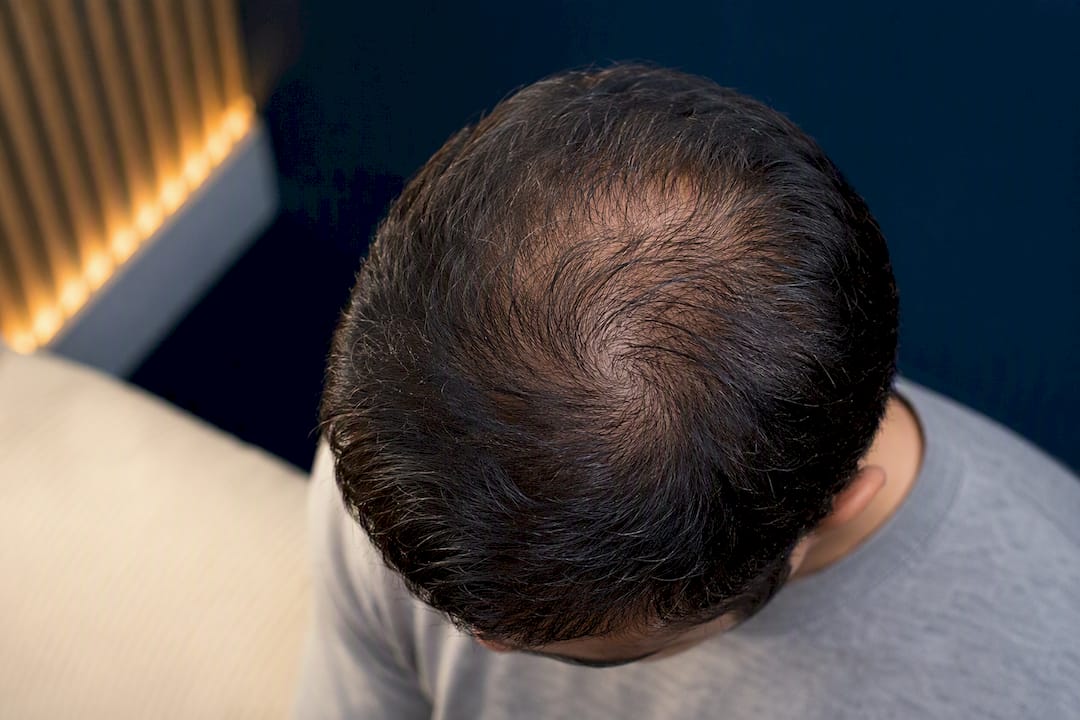 Early vertex thinning visible at crown