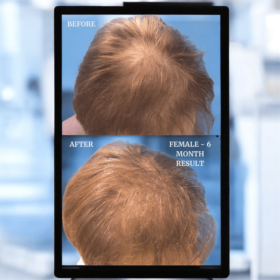 LIVDOR Pro Laser Hair Growth Cap