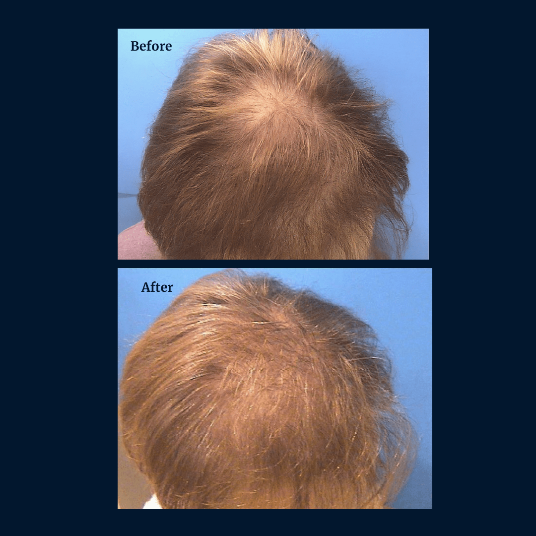 Livdor LIVDOR Pro Laser Hair Growth Cap