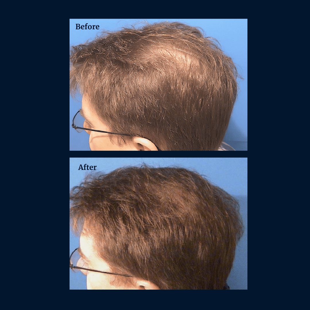 Livdor LIVDOR Pro Laser Hair Growth Cap