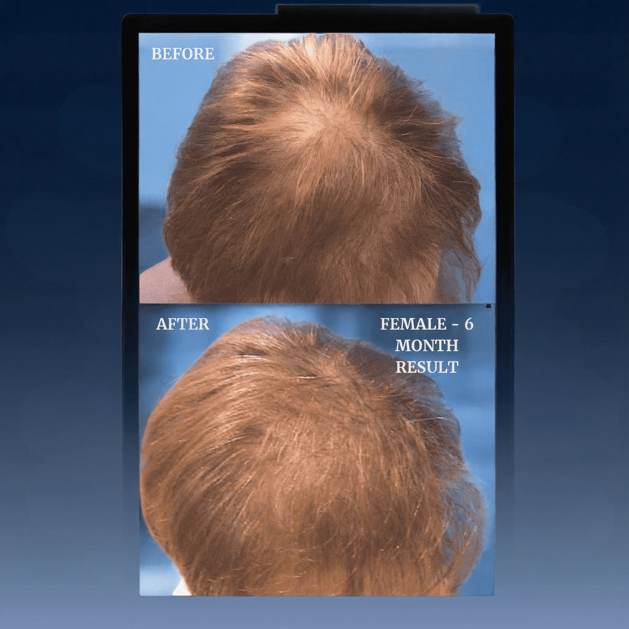 Livdor LIVDOR Pro Laser Hair Growth Cap