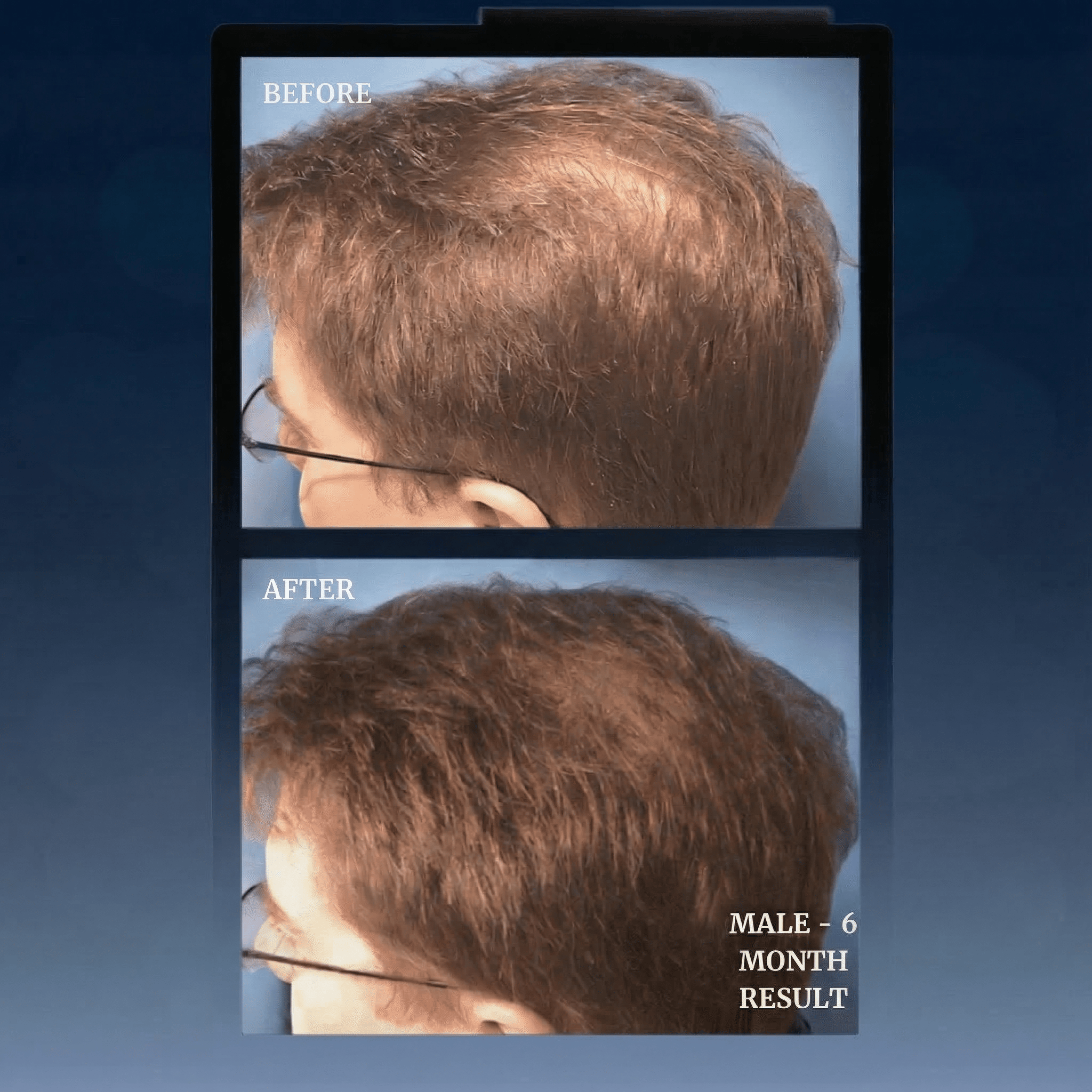 Livdor LIVDOR Pro Laser Hair Growth Cap