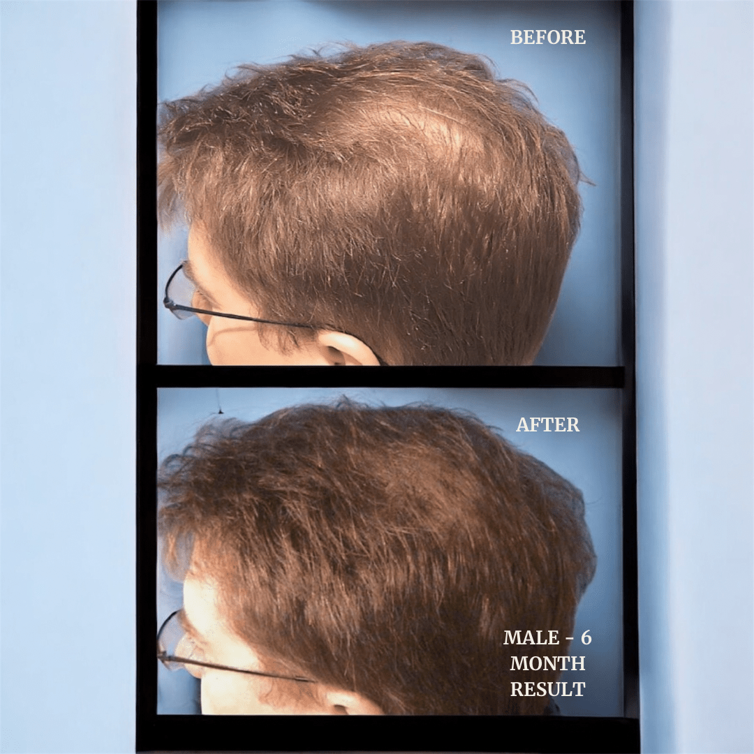 Livdor LIVDOR Pro Laser Hair Growth Cap